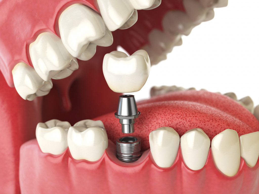 tooth implant dental concept shown through illustration